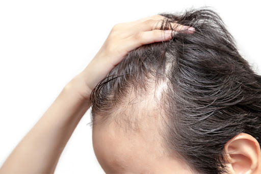 Dermatologo Capilar - Tratamiento Alopecia en Barcelona - Clinica Salud Capilar Tufet